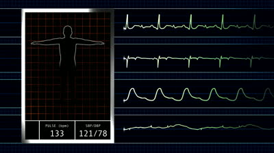 New Cardiac Device Monitors Heart Rates