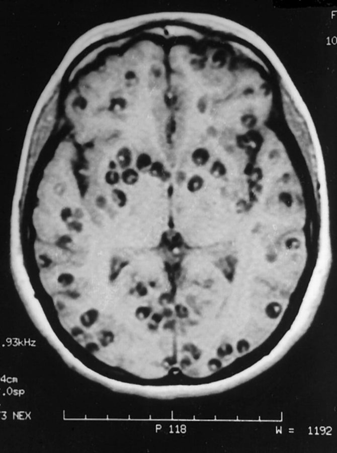 Disease of the Week: Neurocysticercosis